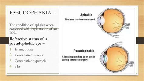 Aphakia: Definition, Causes and Treatment .